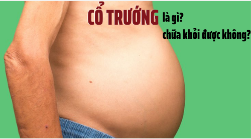 Cổ trướng là gì? Bệnh cổ trướng có chữa khỏi được không?